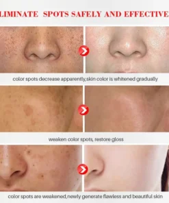 Bloobeac® Blemish Removing Beauty Cream