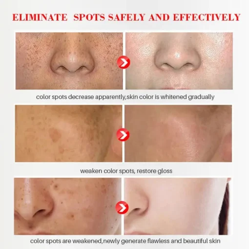Bloobeac® Blemish Removing Beauty Cream