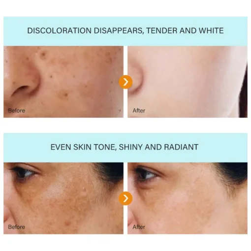 Bloobeac® Blemish Removing Beauty Cream