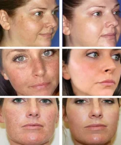 Bloobeac® Blemish Removing Beauty Cream