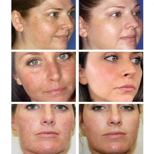Bloobeac® Blemish Removing Beauty Cream