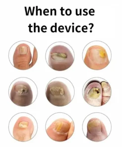 LOVILDS™Fast, Painless Nail Fungus Treatment with Blue Light Technology