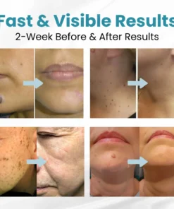 LOVILDS™ Non-Invasive Mole and Wart Removal Laser Pen