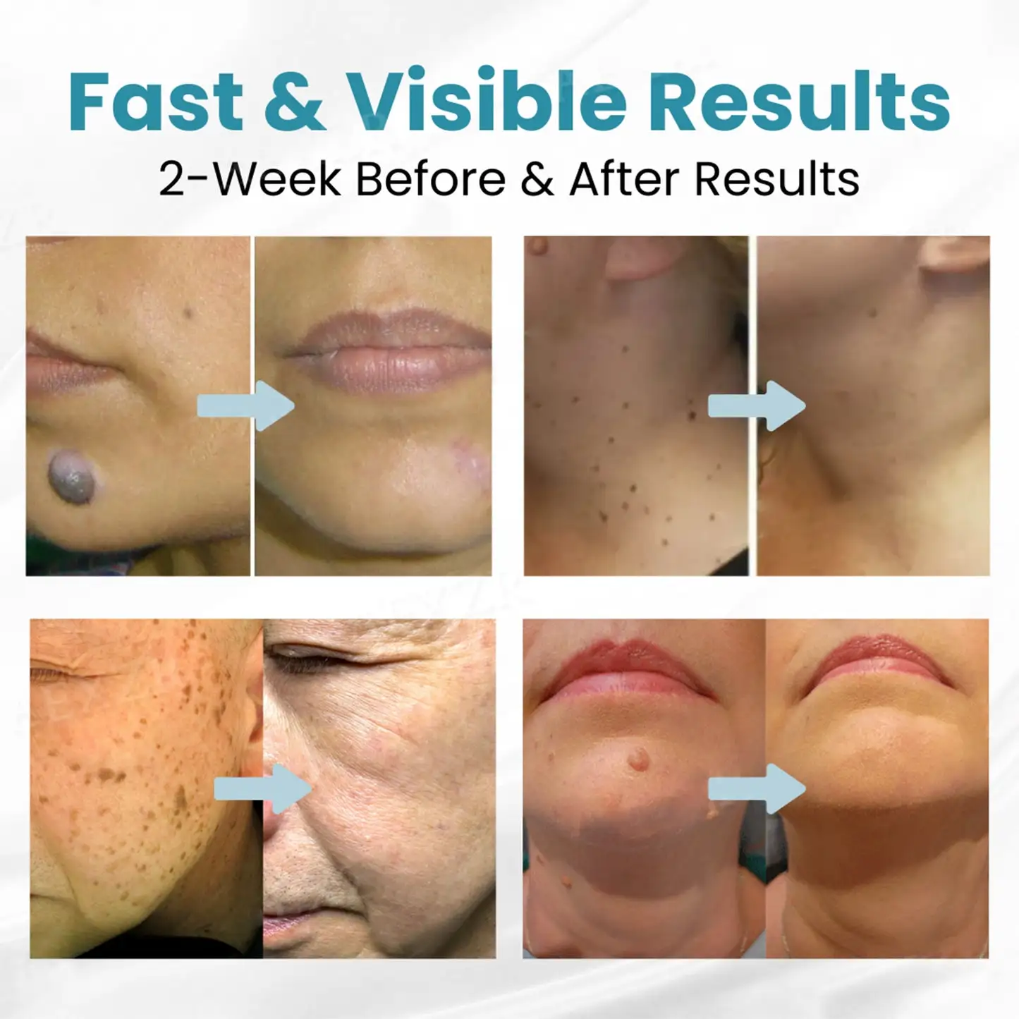 LOVILDS™ Non-Invasive Mole and Wart Removal Laser Pen