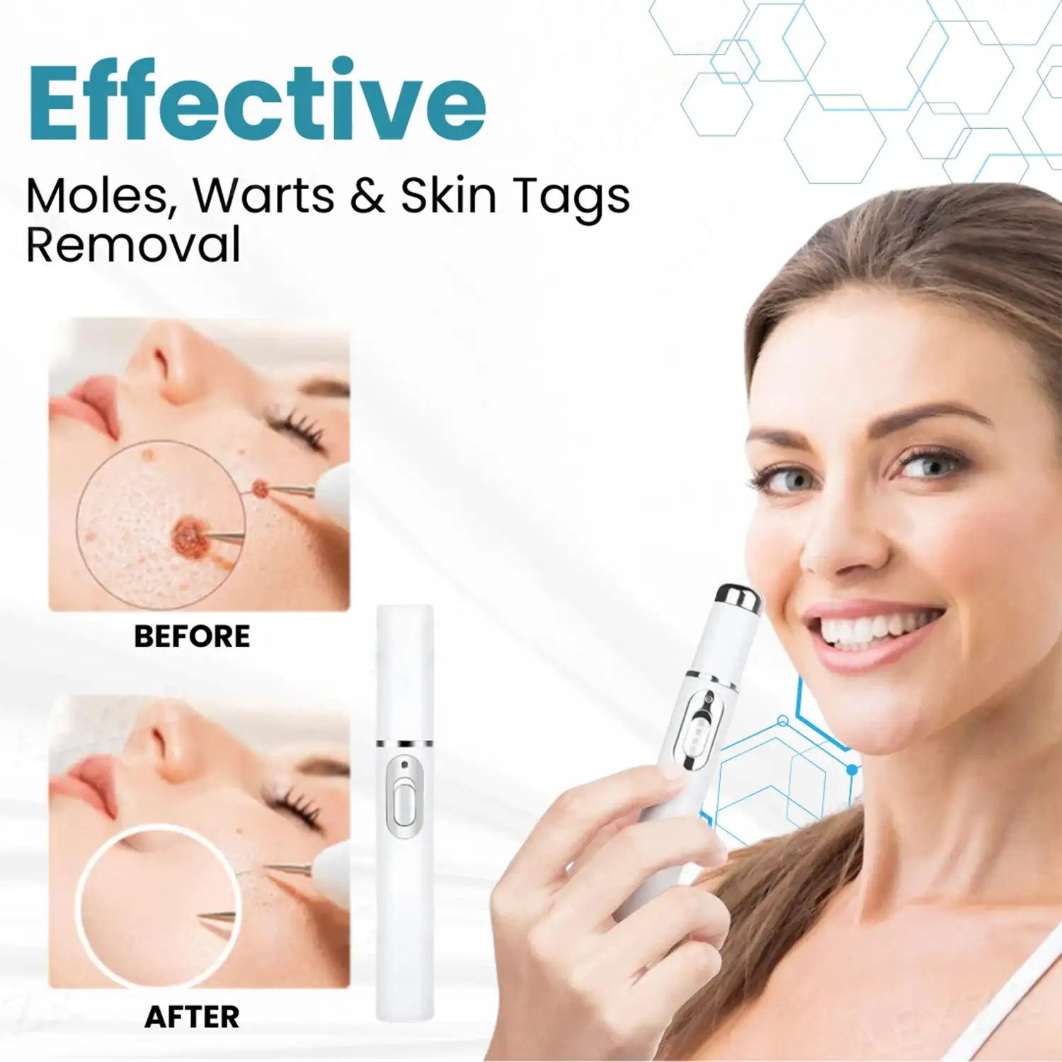 LOVILDS™ Non-Invasive Mole and Wart Removal Laser Pen