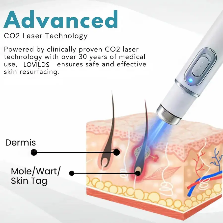 LOVILDS™ Non-Invasive Mole and Wart Removal Laser Pen