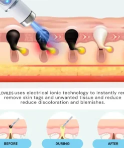 LOVILDS™ Non-Invasive Mole and Wart Removal Laser Pen