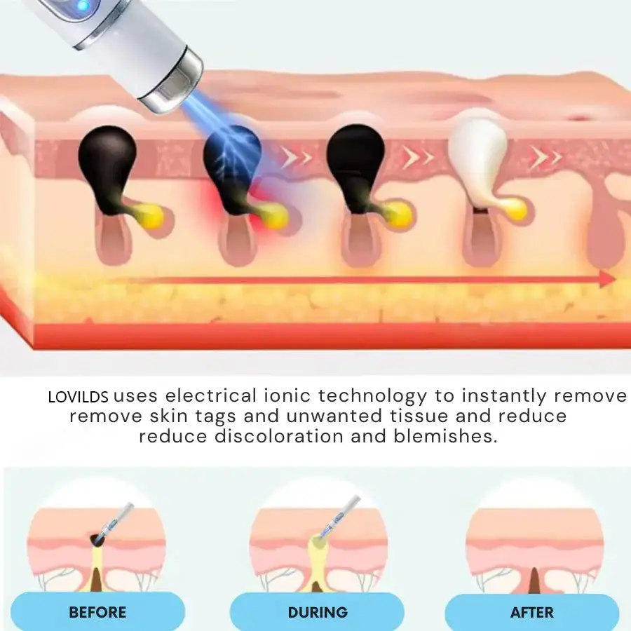 LOVILDS™ Non-Invasive Mole and Wart Removal Laser Pen